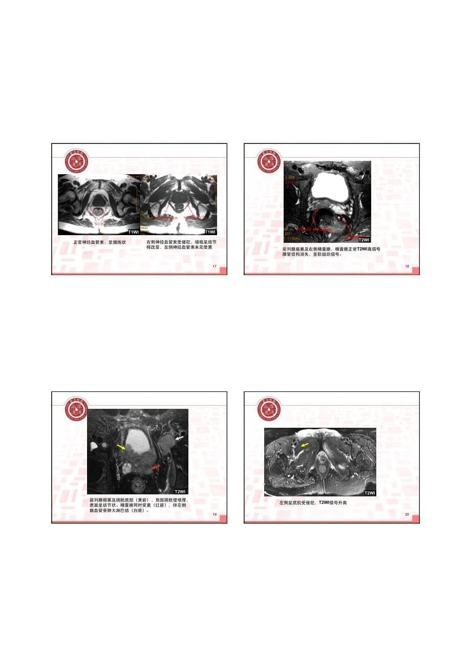 男性生殖系统影像学诊断_第5页
