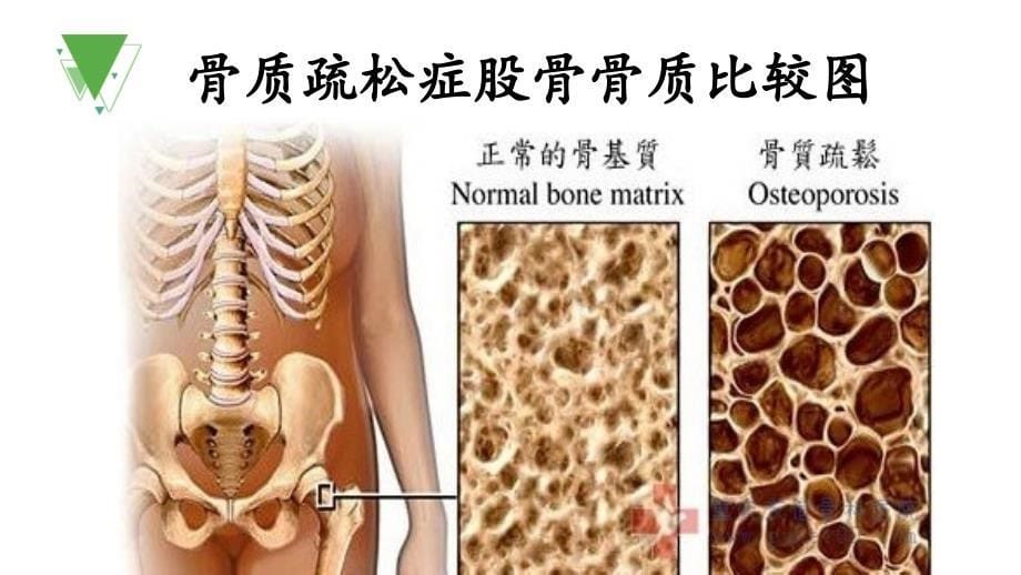 糖尿病干部病房_课件_第5页