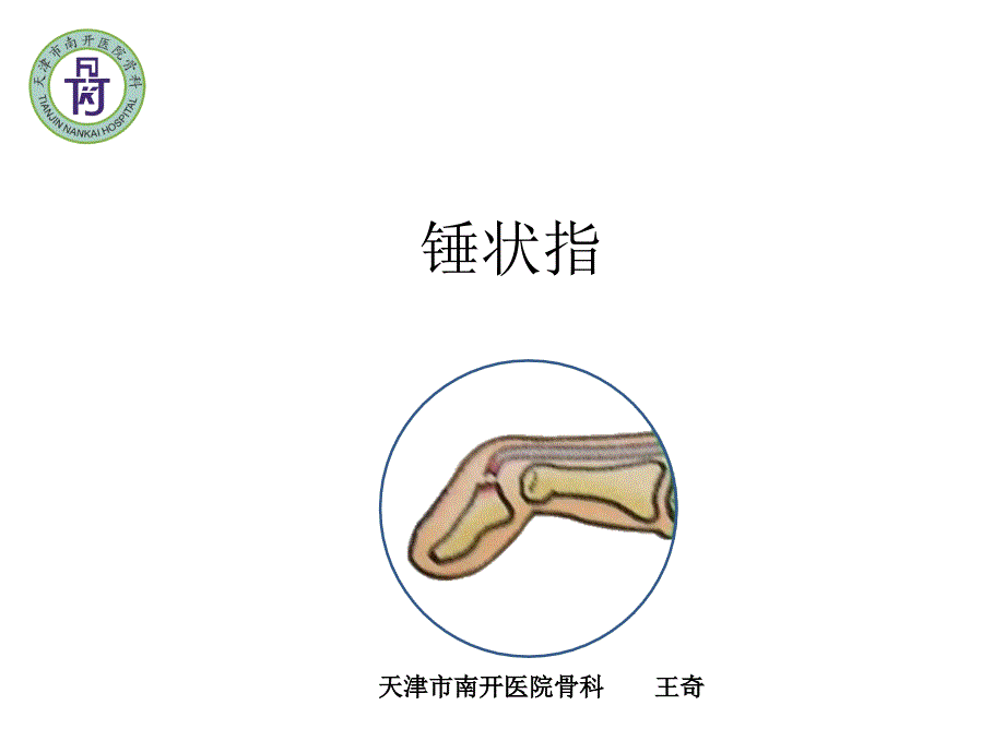 锤状指_第1页