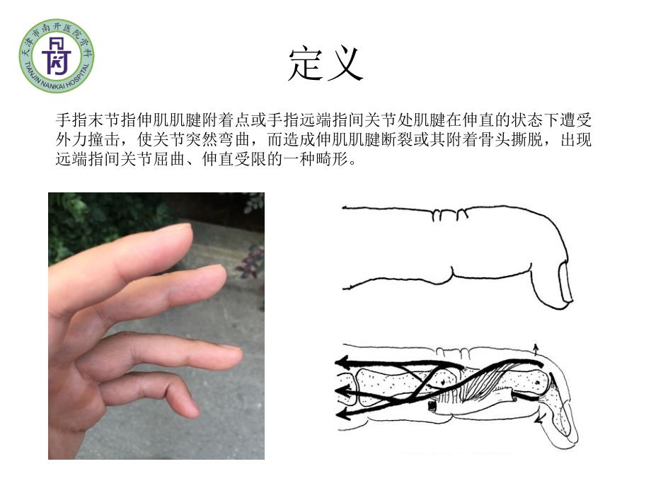 锤状指_第2页