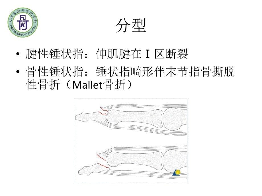 锤状指_第5页