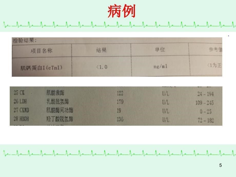 wellens综合征.2016_第5页