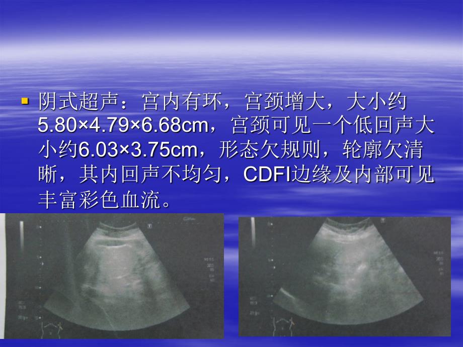 腹腔镜下卵巢移位对年轻宫颈癌应用_第4页