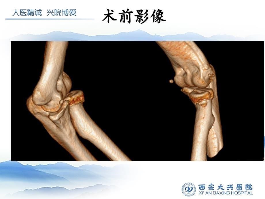 创伤性肘关节不稳_第5页