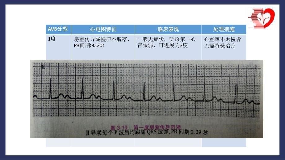 急性心肌梗死伴心率失常病例讨论_第5页