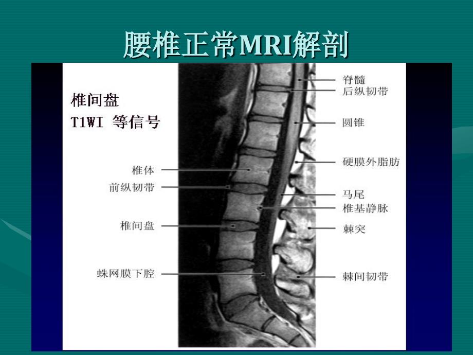 腰椎间盘的mri诊断70571_第3页