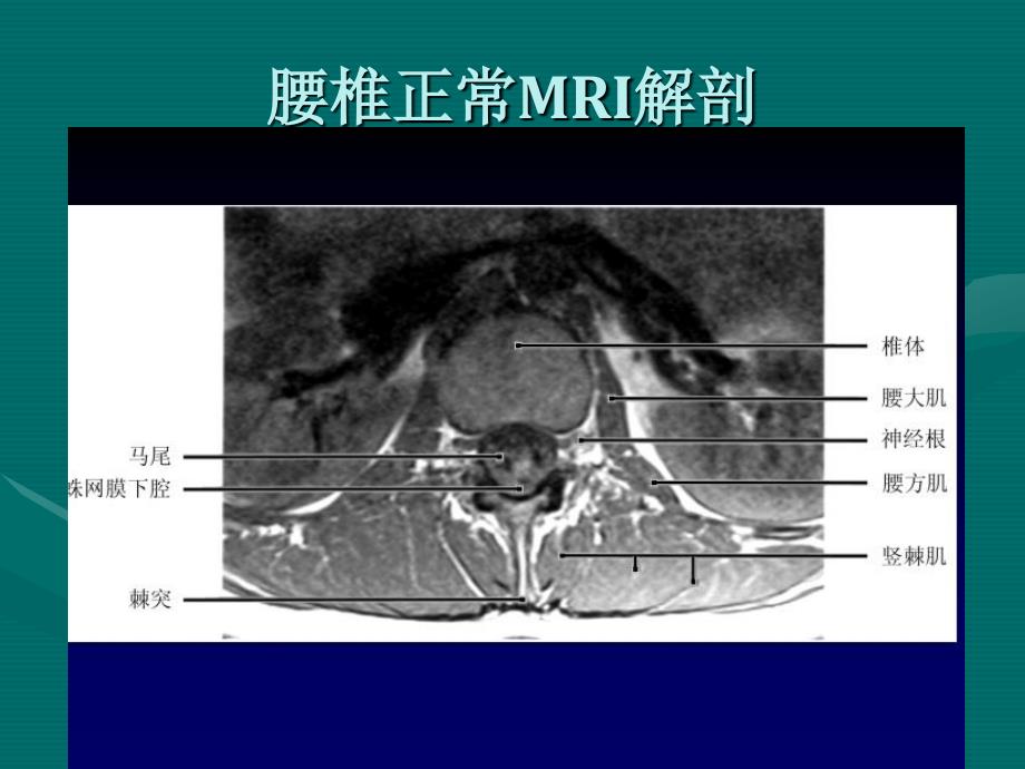 腰椎间盘的mri诊断70571_第4页