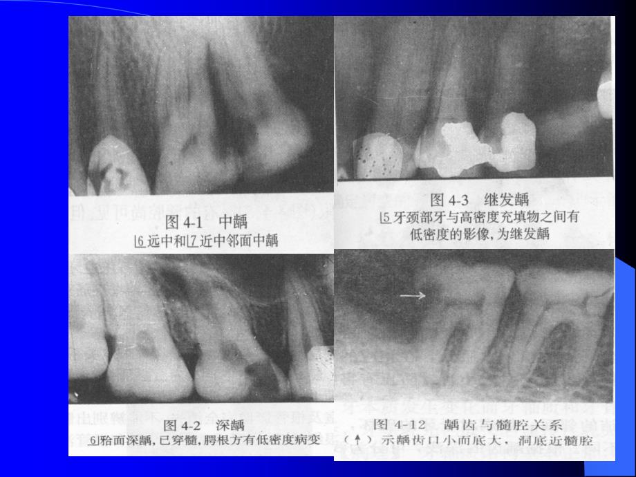 口腔影像学课件ppt课件_第3页