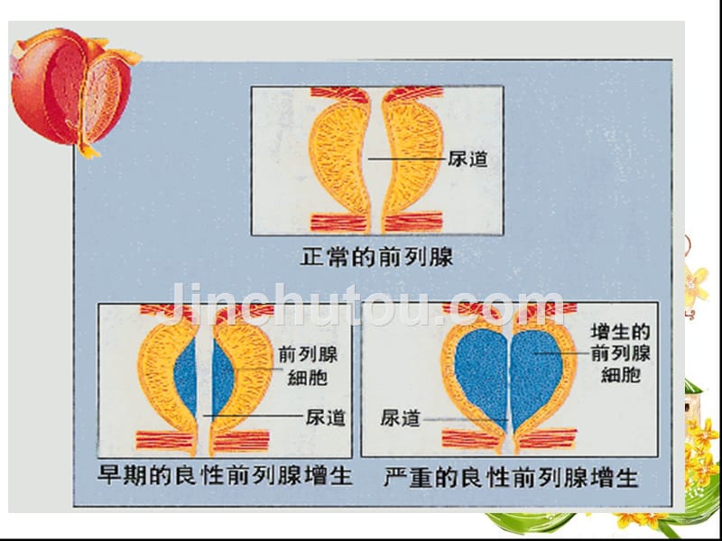 前列腺增生患者的护理ppt课件_第2页