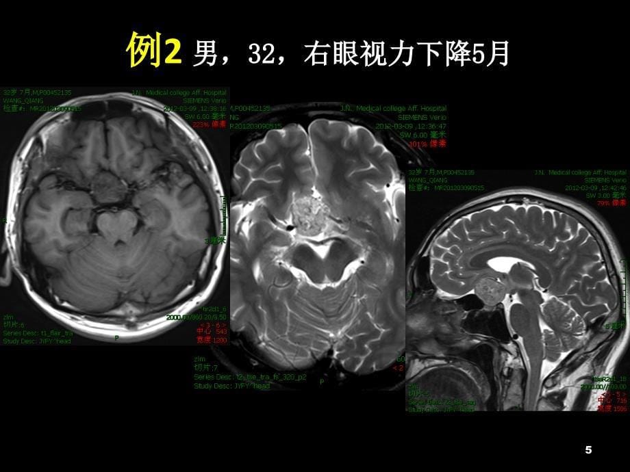 颅底少见占位性病变ppt课件_第5页