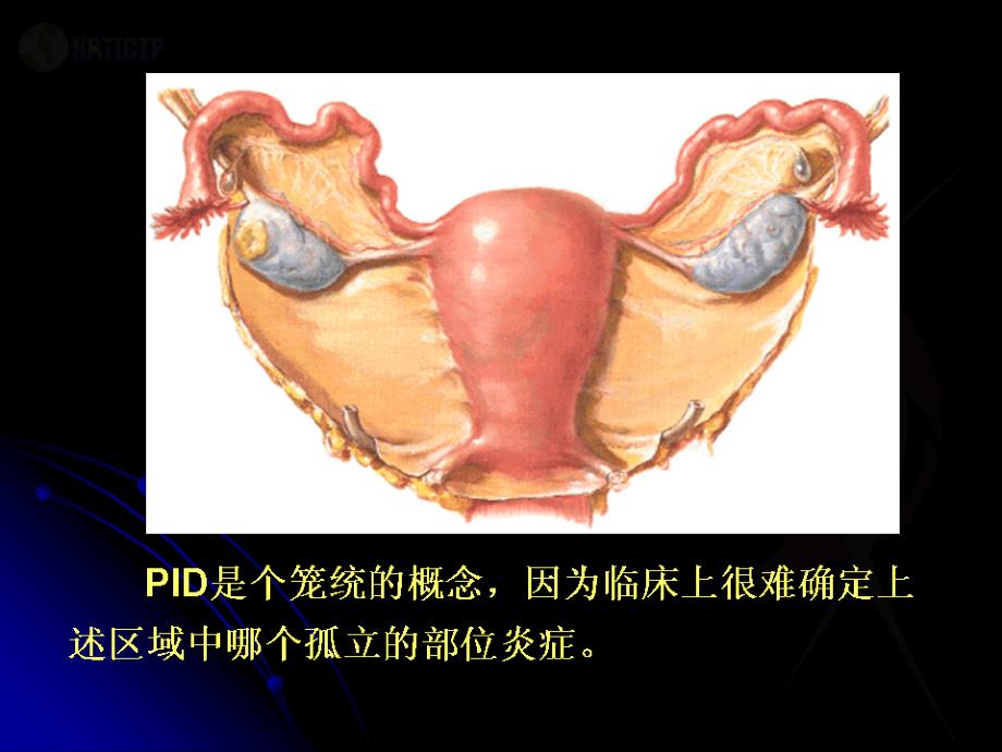 盆腔炎症性疾病诊治新规范ppt课件_第3页