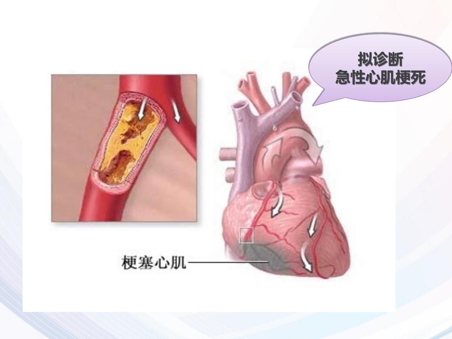 pbl急性心梗ppt课件_第4页