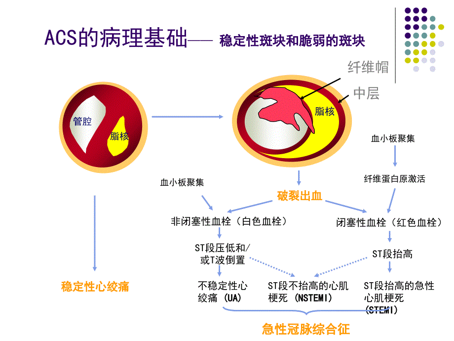 急性冠脉综合征、主动脉夹层、急性肺栓塞ppt课件_第4页