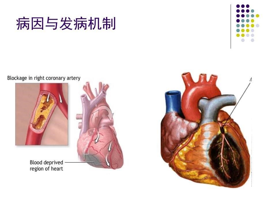 急性冠脉综合征、主动脉夹层、急性肺栓塞ppt课件_第5页
