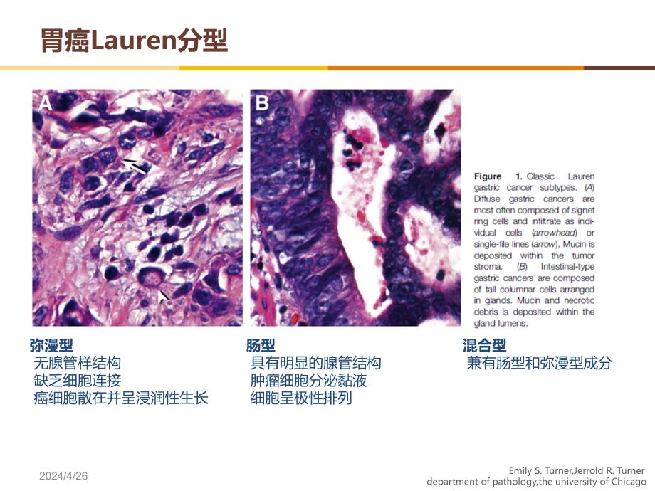 lauren分型对胃癌治疗的价值和意义ppt课件_第4页