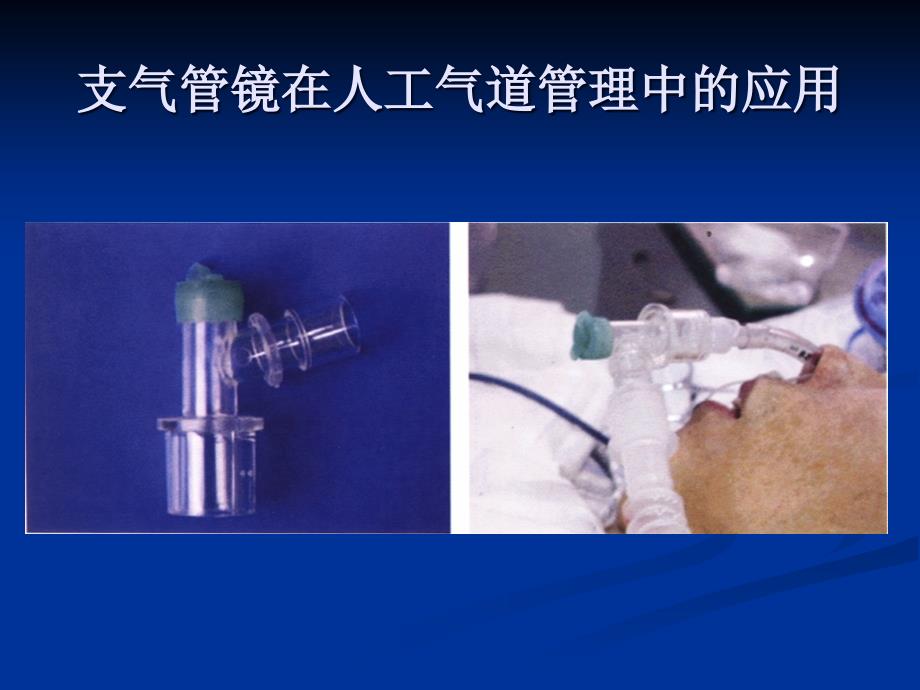 支气管镜在气道管理及气道急症处理中应用_第3页