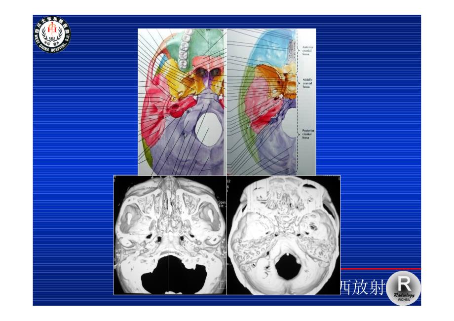 魏懿-正常颅底结构ct解剖_第4页