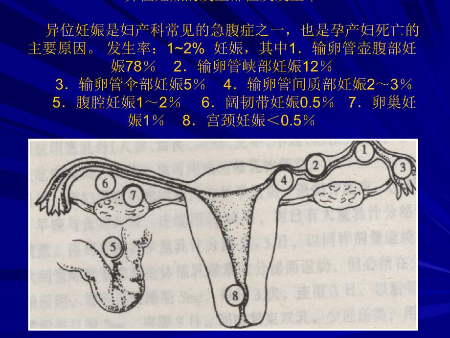 异位妊娠(课件) (1)_第3页