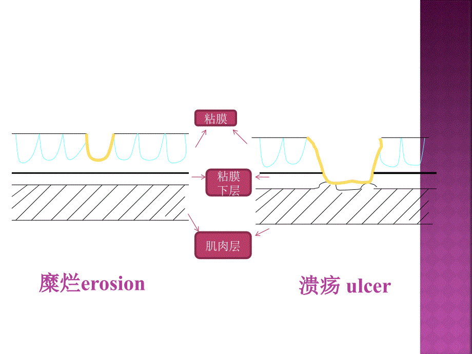 消化性溃疡-gx(1)_第4页