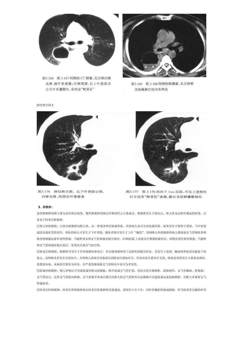 肺部空洞(样)病灶影像诊断_第5页