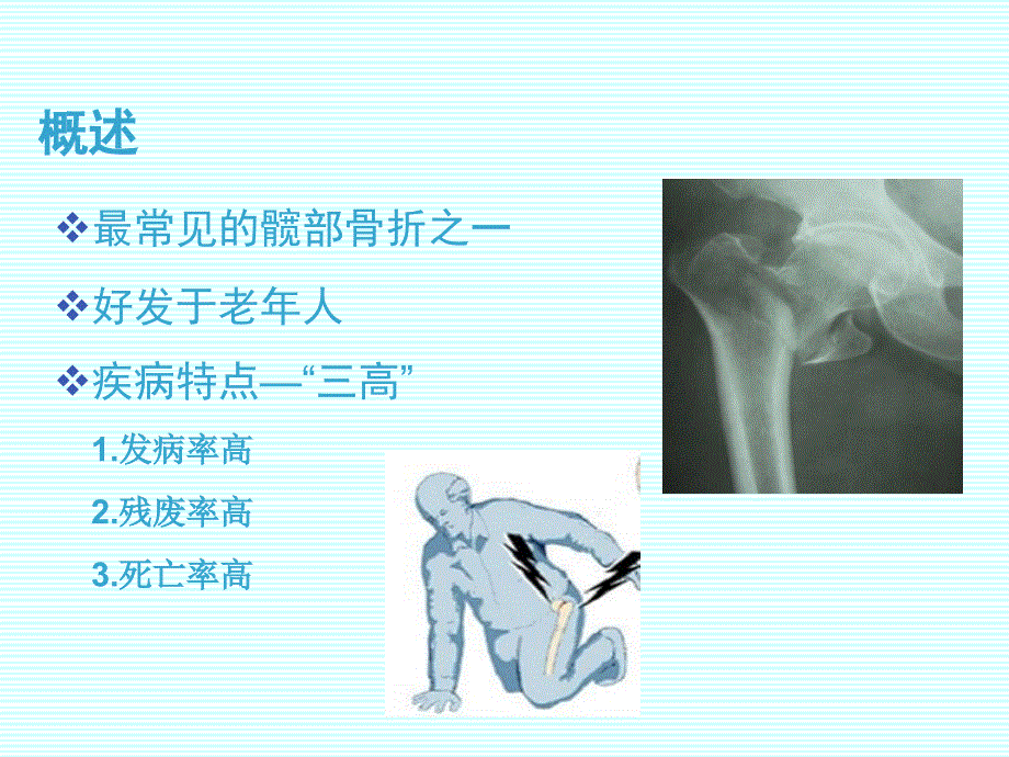 人工股骨头置换治疗老年转子间骨折(最终版)_第2页