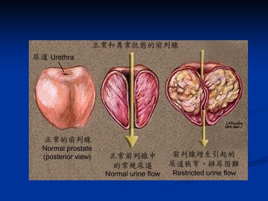 良性前列腺增生病人护理_第5页