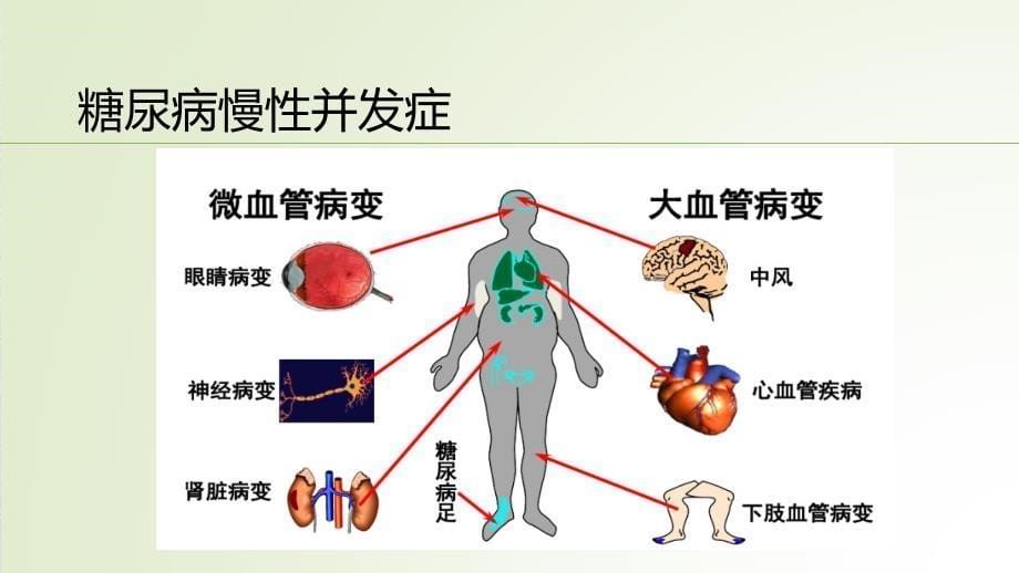 sglt2抑制剂在糖尿病中的应用_第5页