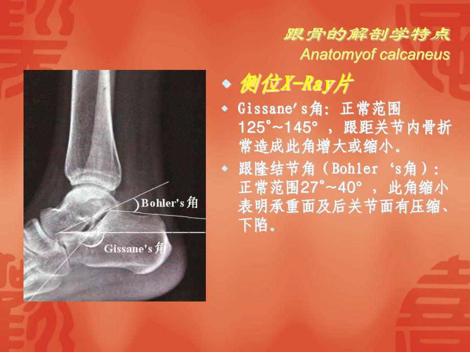 跟骨骨折分型及治疗_第3页