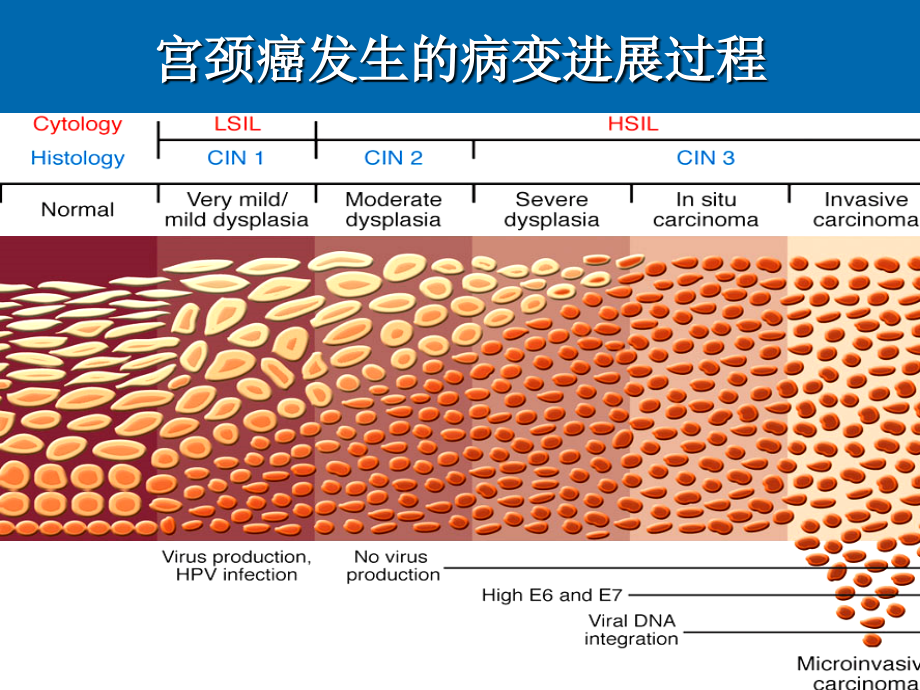 宫颈鳞状上皮内病-李_第3页