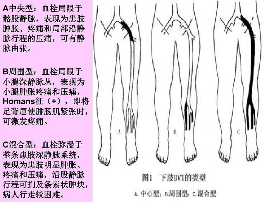 关节外科血栓预防与治疗_第4页