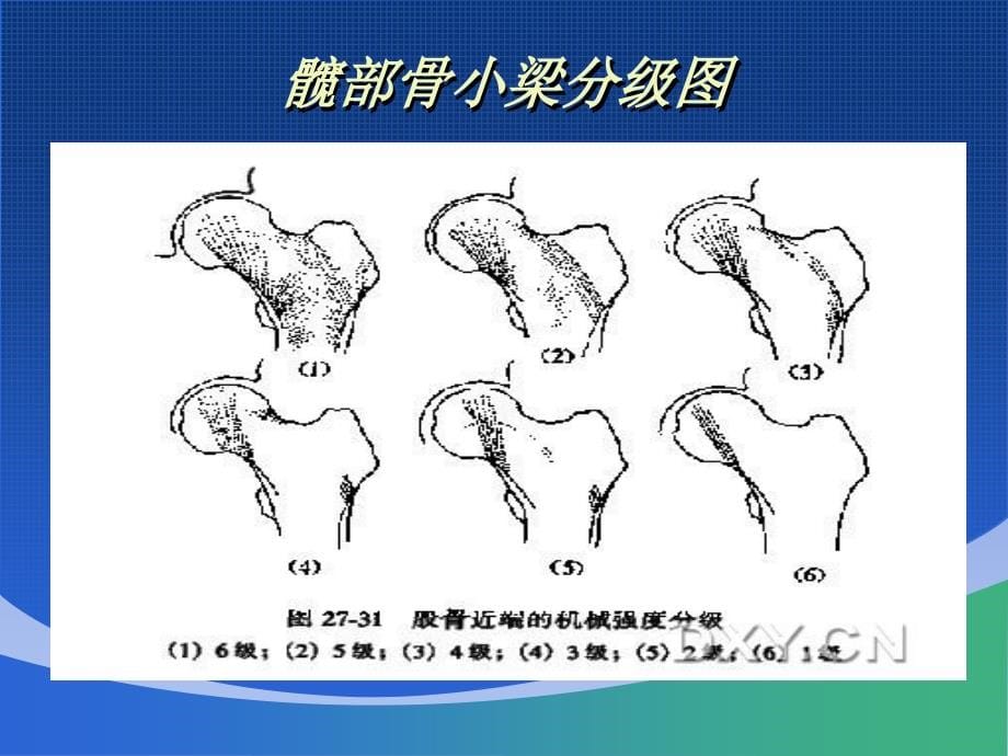 股骨粗隆间骨折治疗_第5页