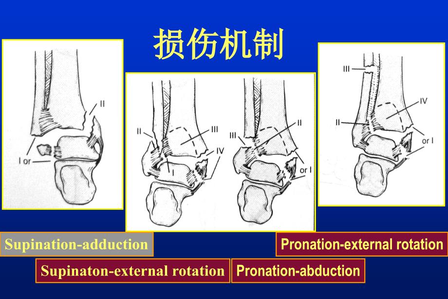 下胫腓联合损伤诊治_第3页