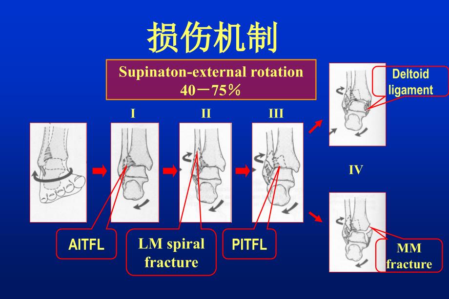 下胫腓联合损伤诊治_第4页