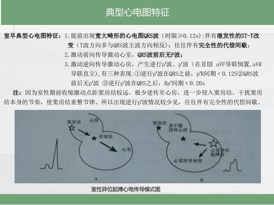 室性早搏的心电图诊断_第4页