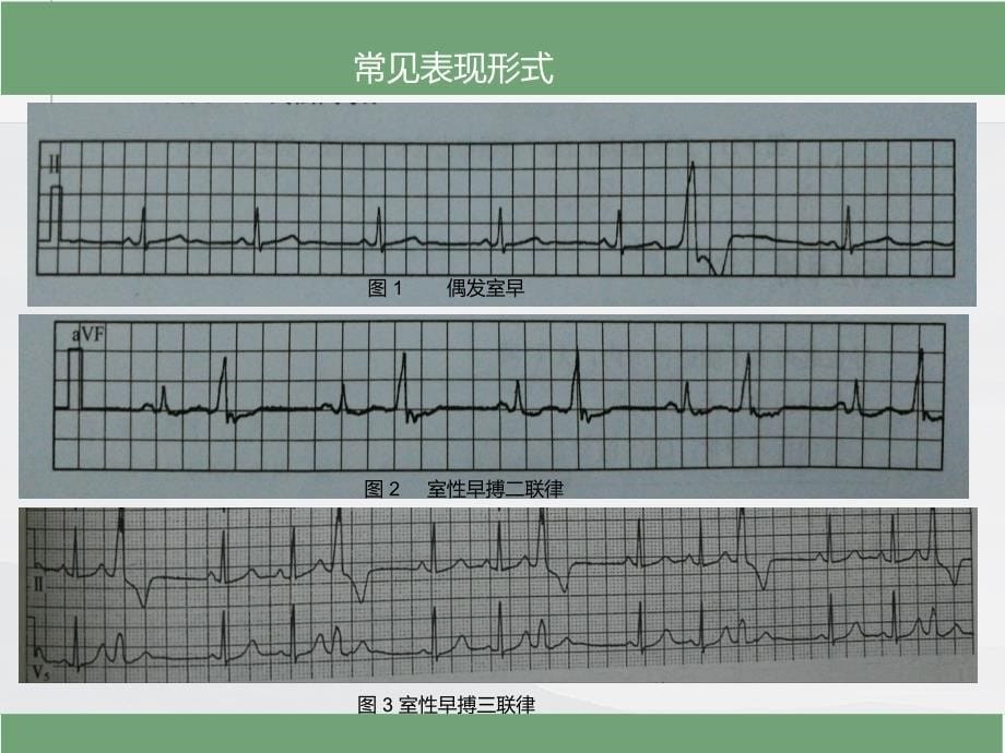 室性早搏的心电图诊断_第5页