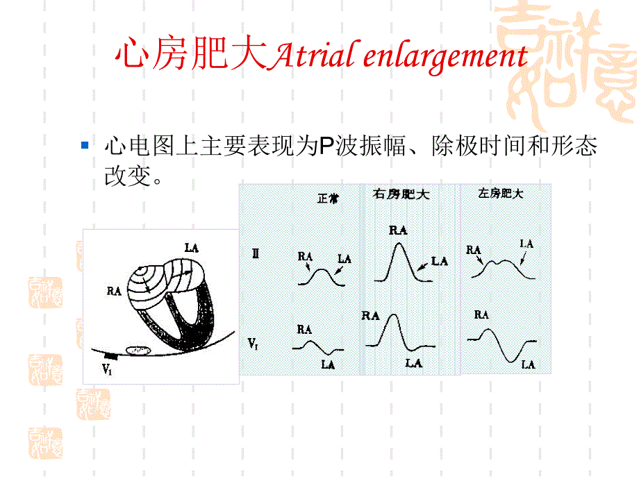 心房心室肥大ppt课件_第3页