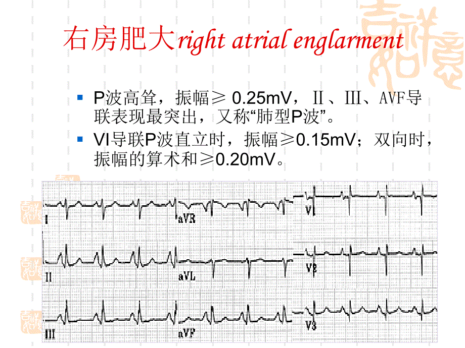 心房心室肥大ppt课件_第4页