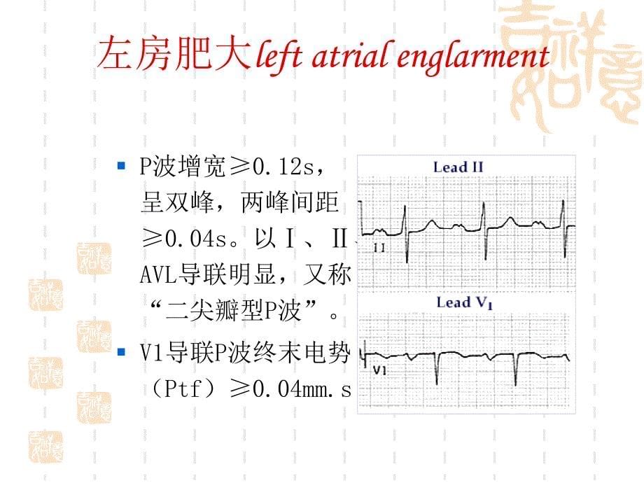 心房心室肥大ppt课件_第5页