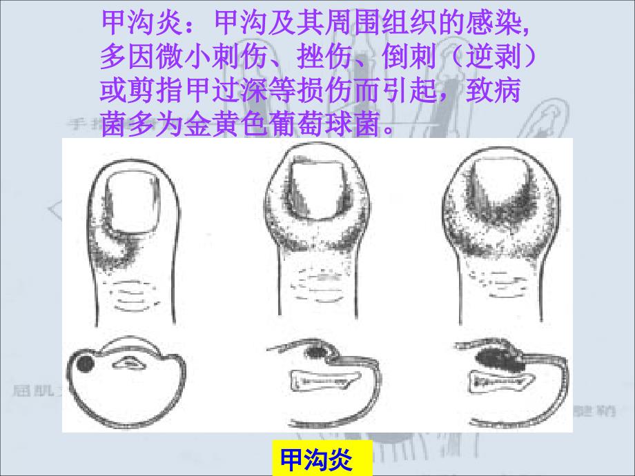 手部的化脓性感染_第2页