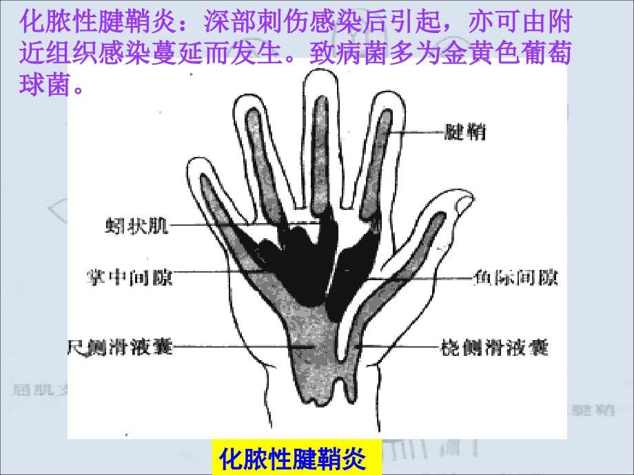 手部的化脓性感染_第4页