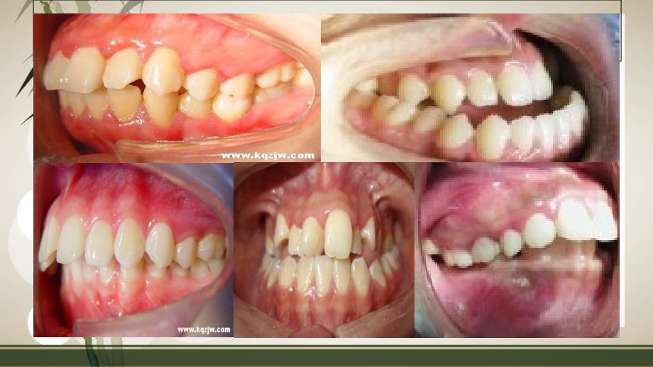 牙齿错颌畸形危害和类_第4页