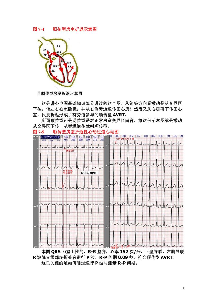 另类心电图讲义-7---室上性心动过速与折返性心律失常(1)_第4页