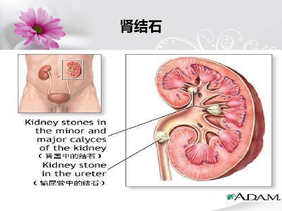 pcnl术肾结石护理_第4页