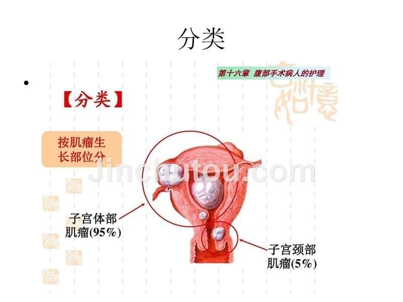 子宫肌瘤个案护理查房_第5页