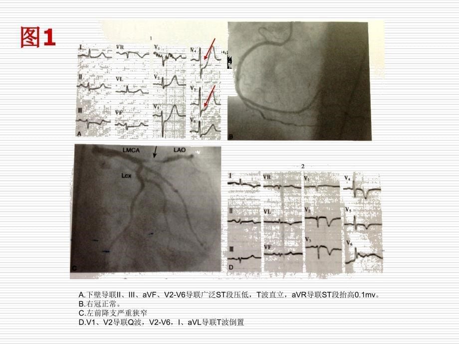 非st段抬高型急性冠脉综合征心电图诊断线索_第5页