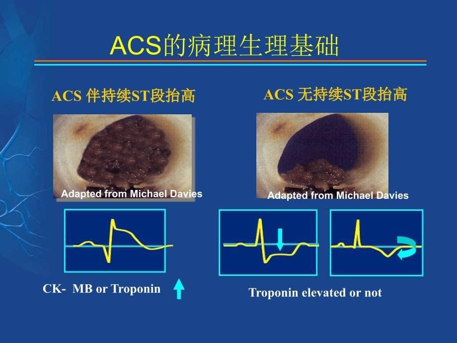 非st段抬高性acs诊疗进展_第5页