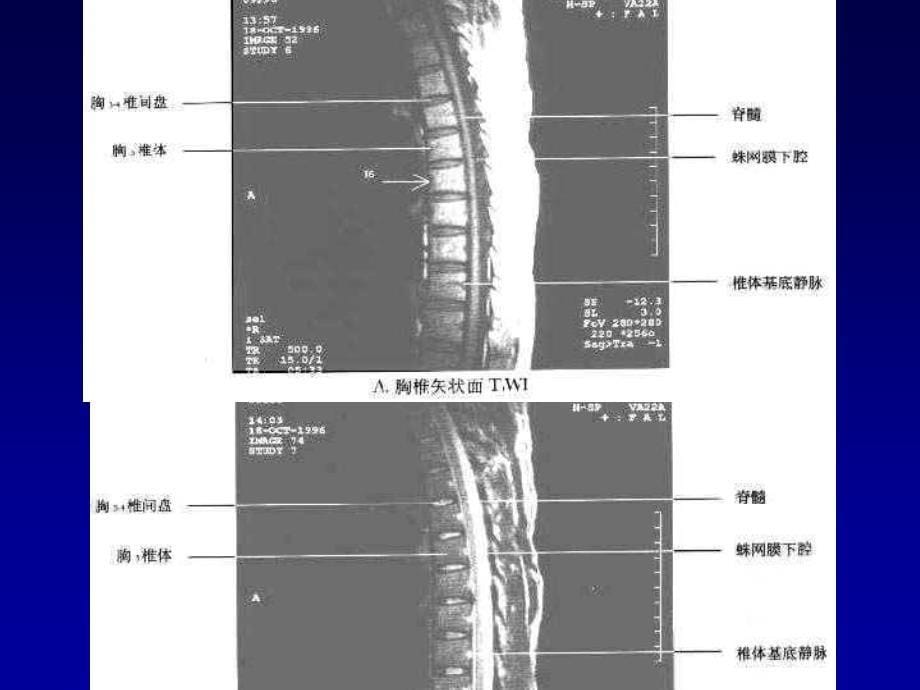 脊柱和脊髓mr诊断_第5页