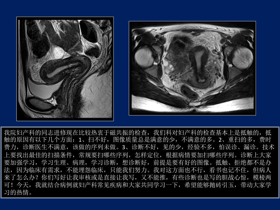 子宫mri诊断课件_第2页