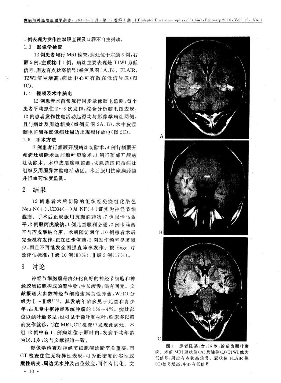 神经节细胞瘤致难治性癫痫的临床诊疗分析_第2页