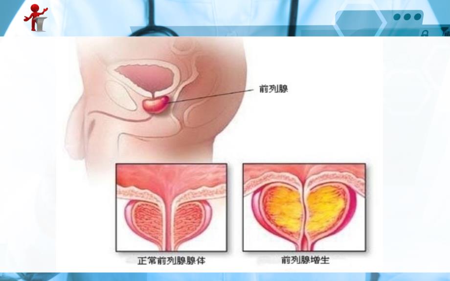 外科护理 良性前列腺增生病人的护理ppt课件_第3页